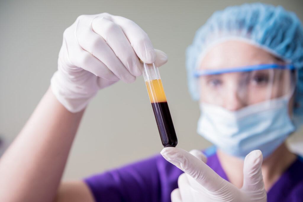 Thérapie par plasma riche en plaquettes (PRP) : historique, utilisations et données probantes 1 Un clinicien examine le plasma PRP dans l'Ouest-du-Québec